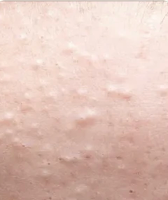 PORES OBSTRUÉS
