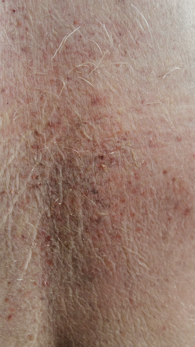 PEAU SÈCHE